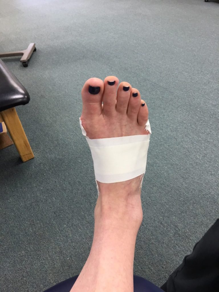 Physical Therapy For Plantar Fasciitis Bacharach